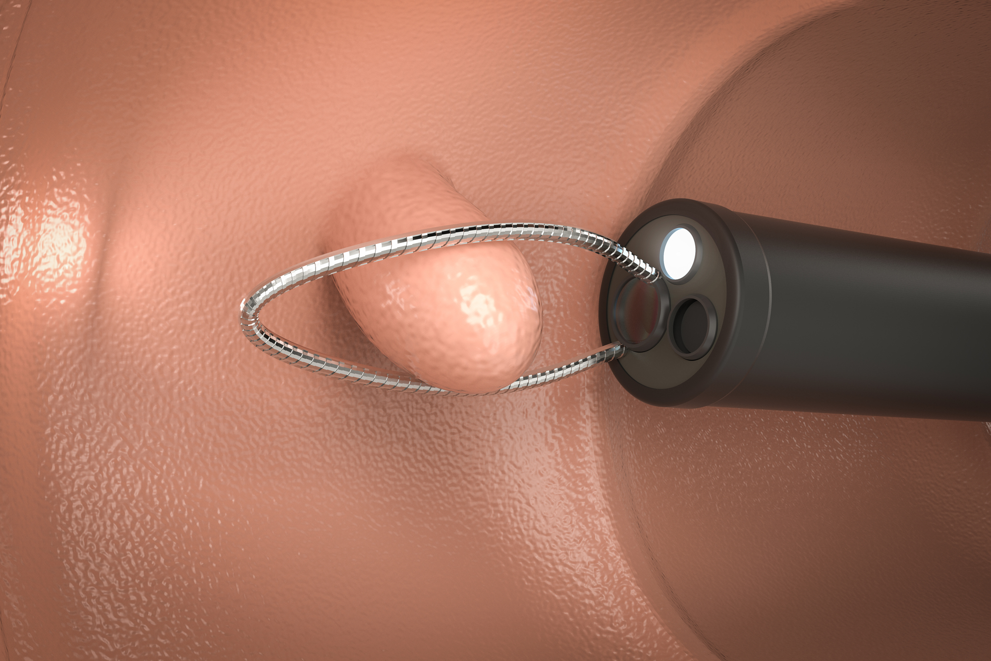 40代から増える！大腸ポリープの予防と対策