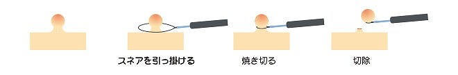 内視鏡的ポリープ切除術（コールド・ポリペクトミー）