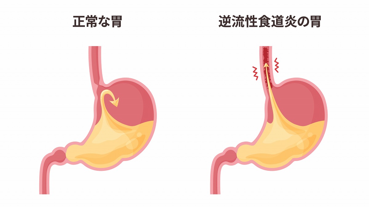 逆流性食道炎とは